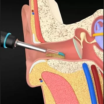 Умная ушная палочка Xiaomi Bebird Smart Visual Ear Rod M9 Pro 3